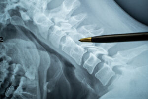Doctor using pen to point to X-ray image of spine 
